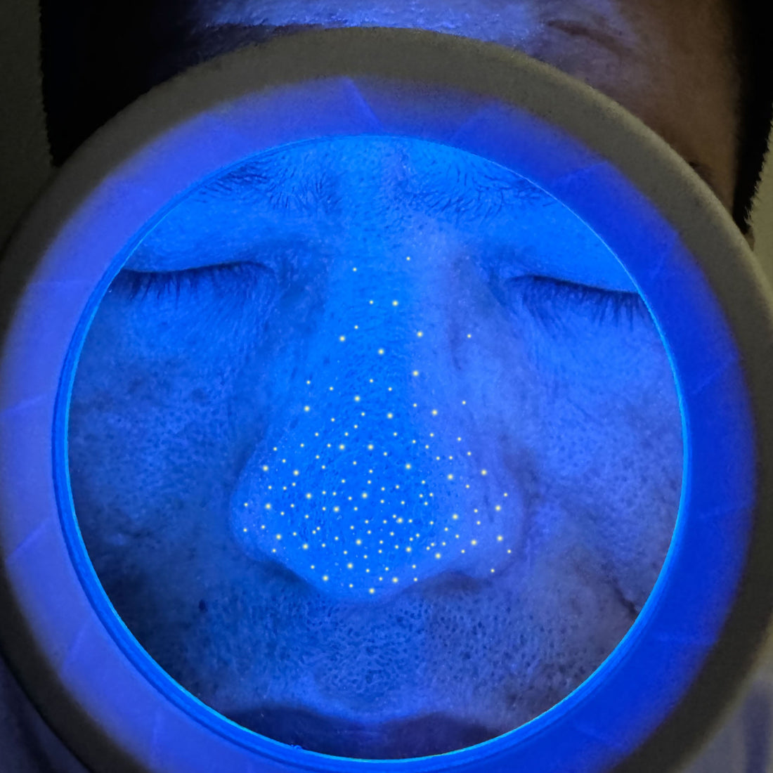 What precautions should be taken when using a Woods lamp?